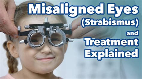 Misaligned Eyes Strabismus And Treatment Explained What Is
