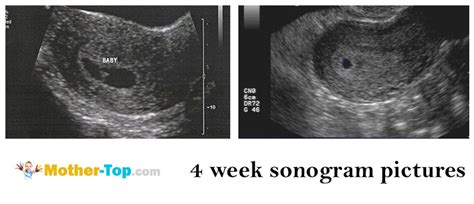 4 weeks pregnant ultrasound pictures