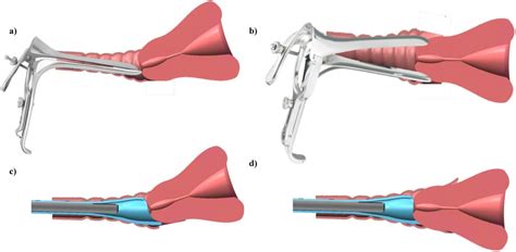 speculum exam technique