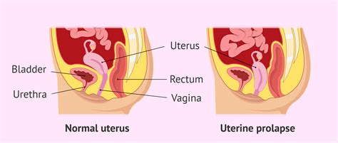 Difference Between Normal Uterus And Uterine Prolapse
