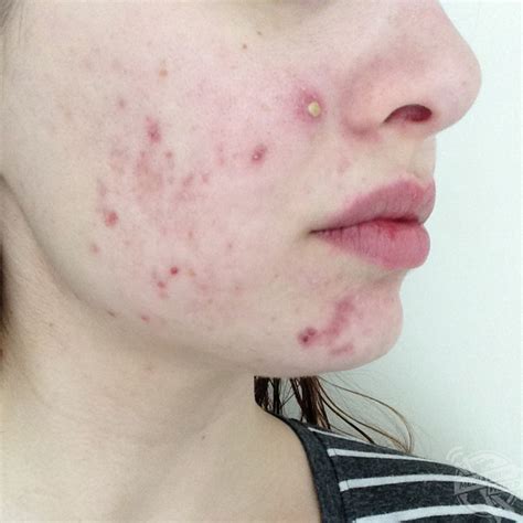 This Girl Developed Severe Cystic Acne That Left Her Face Permanently Scarred But Is Embracing