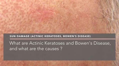 What Are Actinic Keratoses And Bowens Disease And What Are The Causes