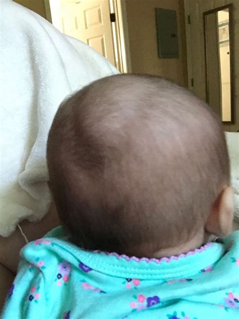 Movable Lump On Back Of Babys Head Nhs Get More Anythinks