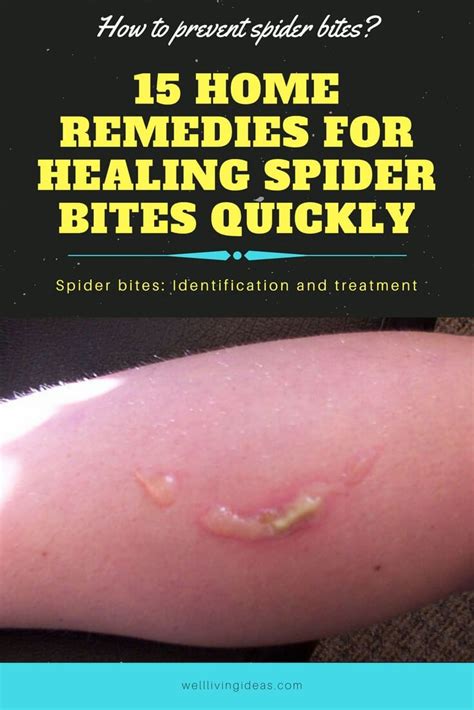 Luxury 80 Of How To Treat Spider Bites At Home Loans Uk Loan Market