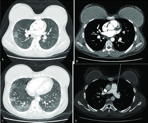 A And C Thoracic Ct Angiography Lung Window With Multiple