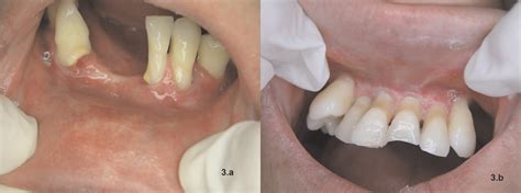 A Gingival Recession On The Anterior Lower Teeth With Changed