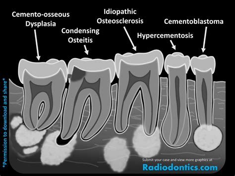 Apical Radiopacities Radiodontics