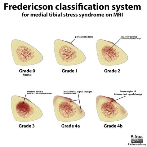 Fredericson Mri Classification Of Medial Tibial Stress Syndrome