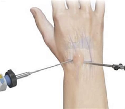 Wrist Arthroscopy Surrey Orthopaedic Clinic