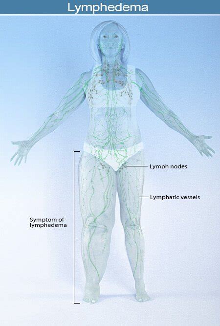 Manual Lymph Drainage And Lymphedema Peoplebeatingcancer