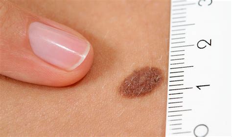 Skin Cancer Symptoms How To Tell The Difference Between Cancerous And Non Cancerous Moles