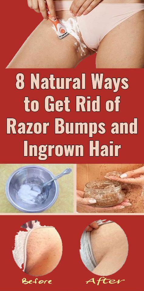 How To Get Rid Of Hair Bump Scars Programsrun Com