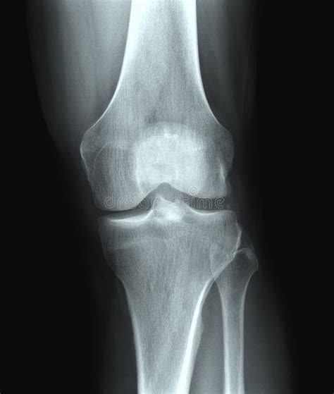 X Ray Knee Stock Image Image Of Rehabilitation Trauma 19391165