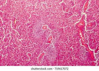 Hyaline Degeneration Splenic Artery Light Photomicrograph Stock Photo