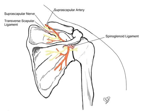 Persistent Shoulder Pain Due To A Suprascapular Nerve Injury In The
