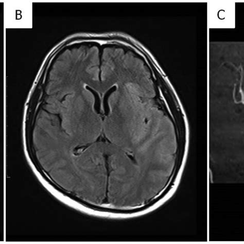 Diffusion Weighted Magnetic Resonance Imaging A And Fluid Attenuated