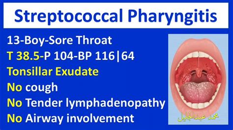 Streptococcal Pharyngitis Usmle Plab Mrcp Emergency Medicine