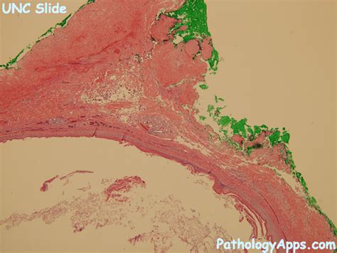 Dermoid Cyst Pathology