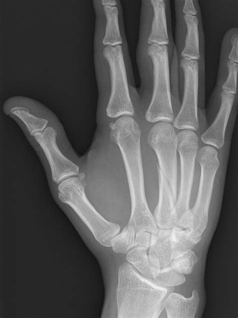 Metacarpal Fracture Treatment Melbourne And Gippsland