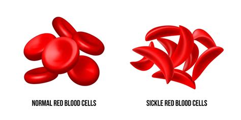 Premium Vector Sickle Cell Disease The Difference Of Normal Red Blood