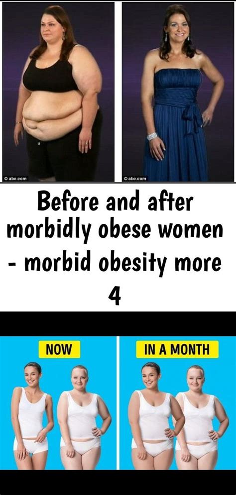 Before And After Morbidly Obese Women Morbid Obesity More Obesity