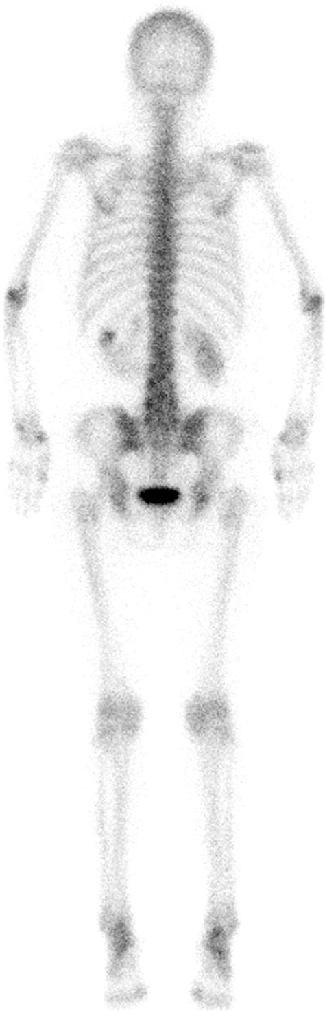 Bone Scintigraphy May Help Differentiate Bone Sclerotic Lesions From