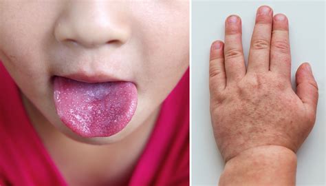 4 Top Tips About Scarlet Fever That Every Parent Should Know