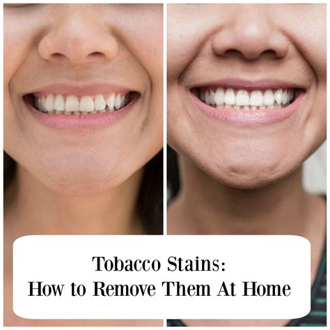 But it also means that it is essential. Tobacco Stains On Teeth: The cause and available solution ...