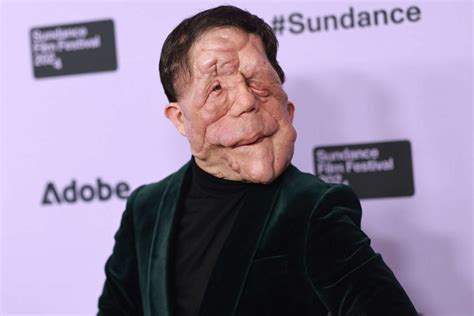 Adam Pearson Speaks Out Against How Actors With Disabilities Are Only