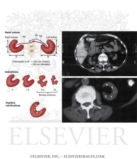 Nephropathy: Analgesic Nephropathy Symptoms