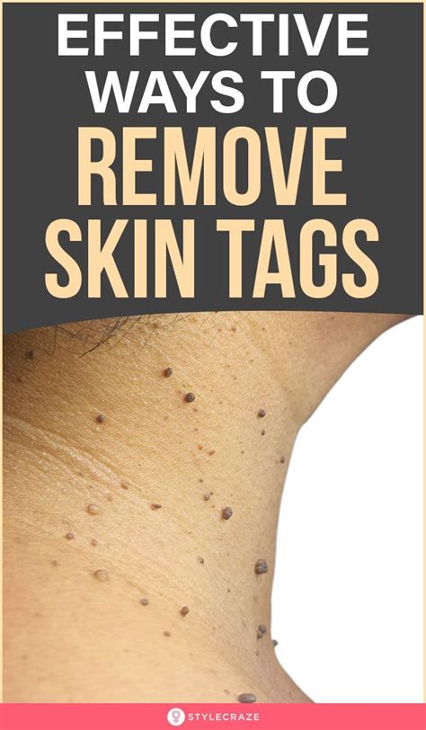12 Effective Home Remedies To Remove Skin Tags Skin Tag Skin Natural