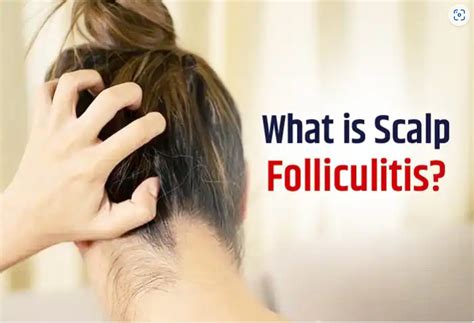Scalp Folliculitis Causes Symptoms Treatment And Prevention Vizz Blog