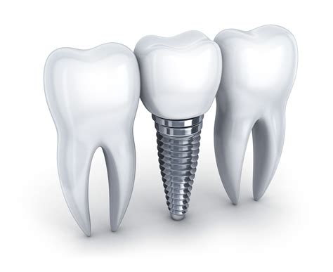 Dental Implants Explained Site Title