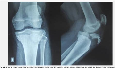 Figure 1 From Tibial Tuberosity Fracture Type Iii B In Adolescents
