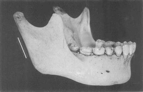 This Adult Female Mandible Exhibits The Straight Posterior Border Of