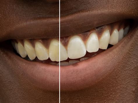 How To Whiten Teeth In Photoshop