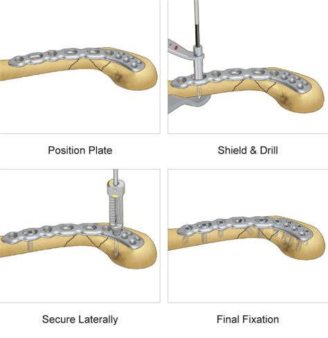 Superior Lateral Clavicle Plate Upper Extremity Fixation Trimed Inc