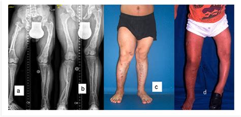 Figure 1 From Windswept Lower Limb Deformities In Patients With