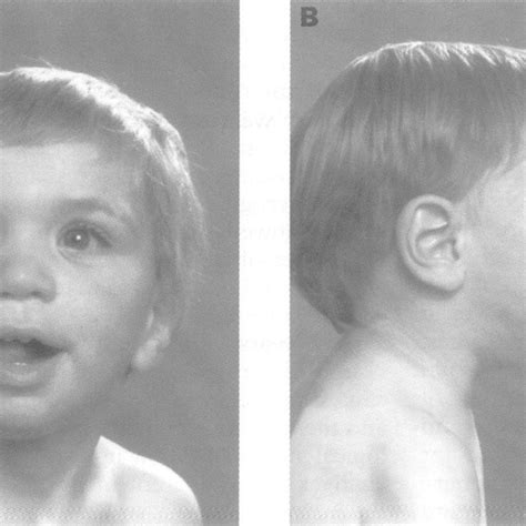 Pdf Familial Neurofibromatosis Type 1 Associated With An Overgrowth