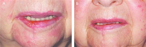 Actinic Cheilitis Of The Lower Lip Of A 78 Year Old Patient A And
