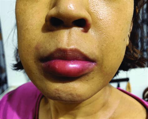 Lip Angioedema During The Second Dfx Graded Challenge And Treating