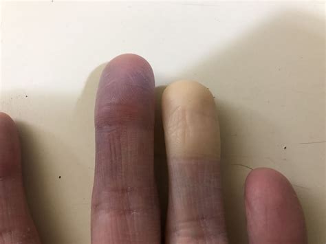 Numbness In Left Hand General Center