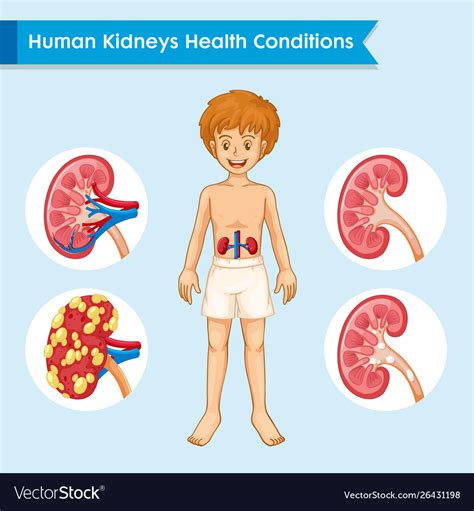 Scientific Medical Kidney Disease Royalty Free Vector Image