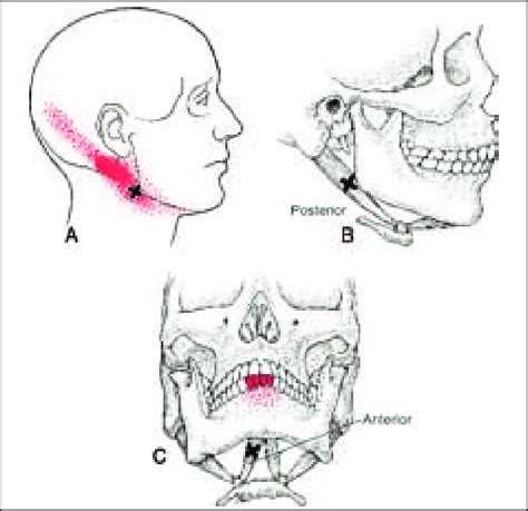 A B C Referred Pain Pattern From Trigger Points X In The Posterior Download Scientific