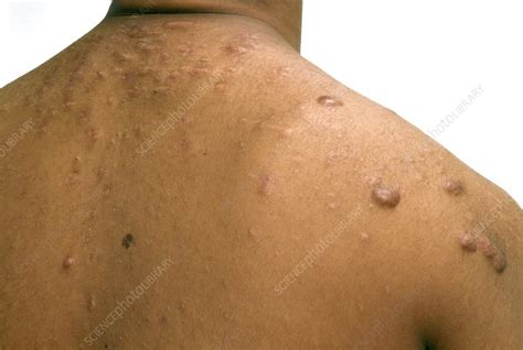 Cystic Acne On The Shoulders Stock Image C0151625 Science Photo