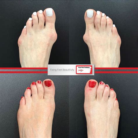 Bunion On Both Sides And Both Feet No Problem We Can Fix Both Still Keep You On Your Feet
