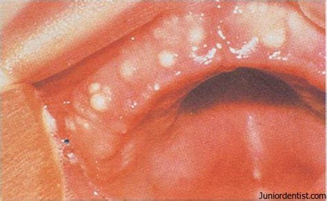 Pathology Outlines Gingival Cyst Newborn