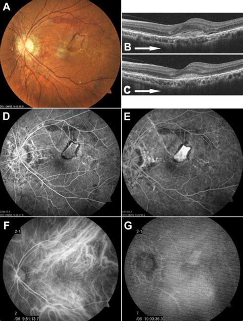 Left Fundus Findings 3 Months After Injury Notes A Fundus