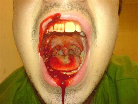 Infected Tonsils Gallery Ebaums World