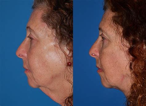 Patient 122406481 Laser Assisted Weekend Neck Lift Before And After
